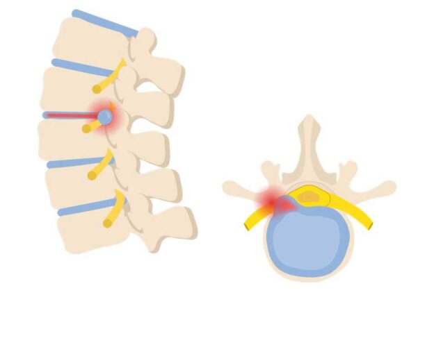 Therapie Radikulopathie Archive Physio Meets Science GmbH