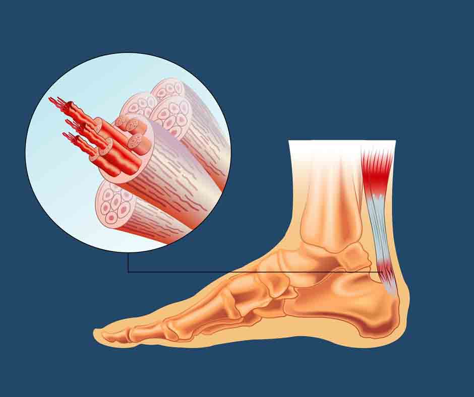 Achillessehnenruptur Therapie Archive - Physio Meets Science GmbH